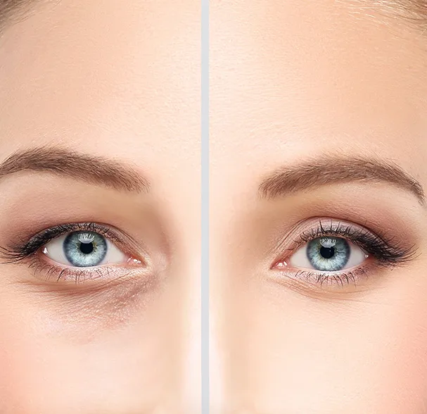 Je regrette ma blépharoplastie